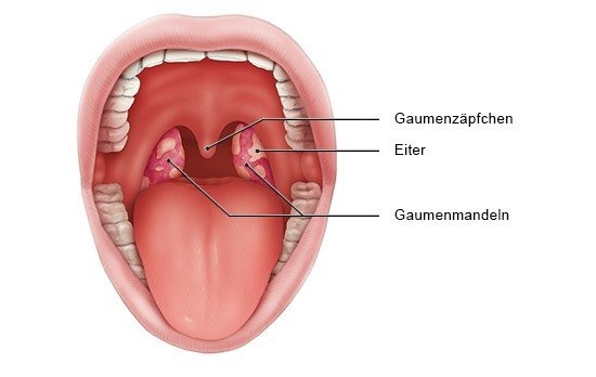 Leichte Mandelentzündung: Ursachen, Symptome und schnelle Behandlungstipps